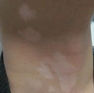 长春博润皮肤病医院